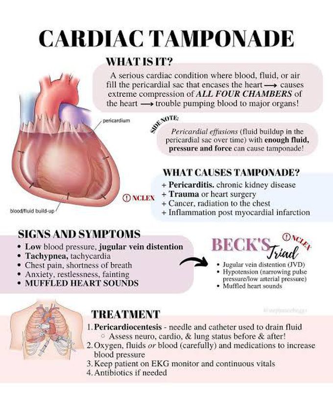 Cardiac Tamponade