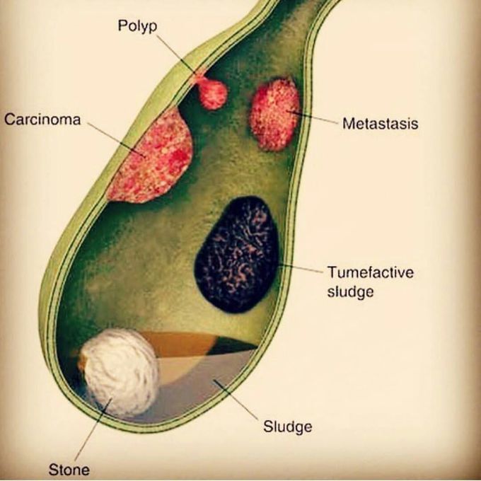 Disease of gallbladder