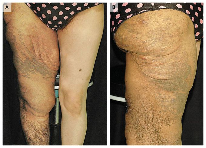 Elephantiasis Neuromatosa