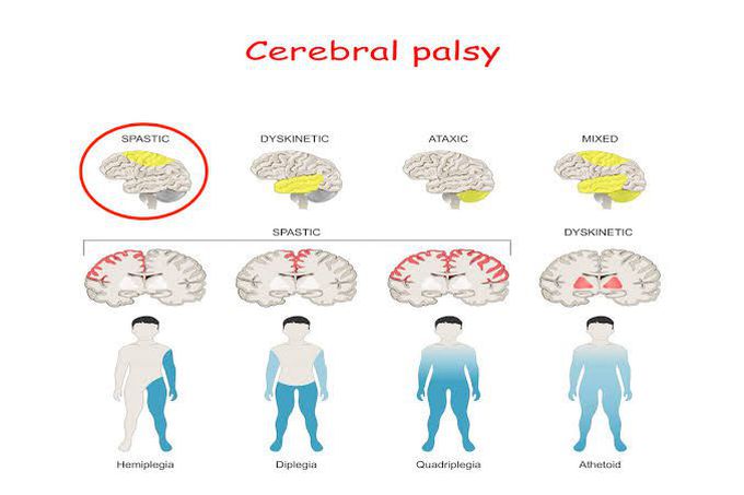 Cerebral palsy