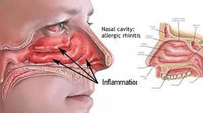 Catarrh