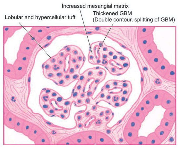 Membranoproliferative GN, light microscopic appearance.