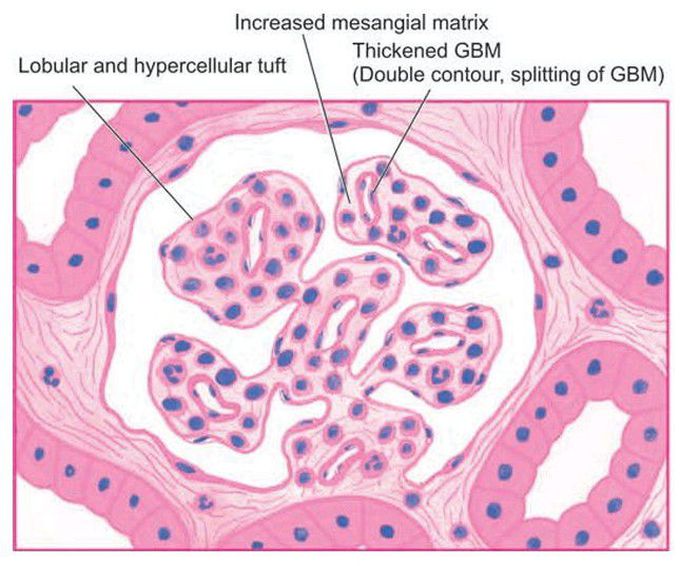 Membranoproliferative GN, light microscopic appearance.