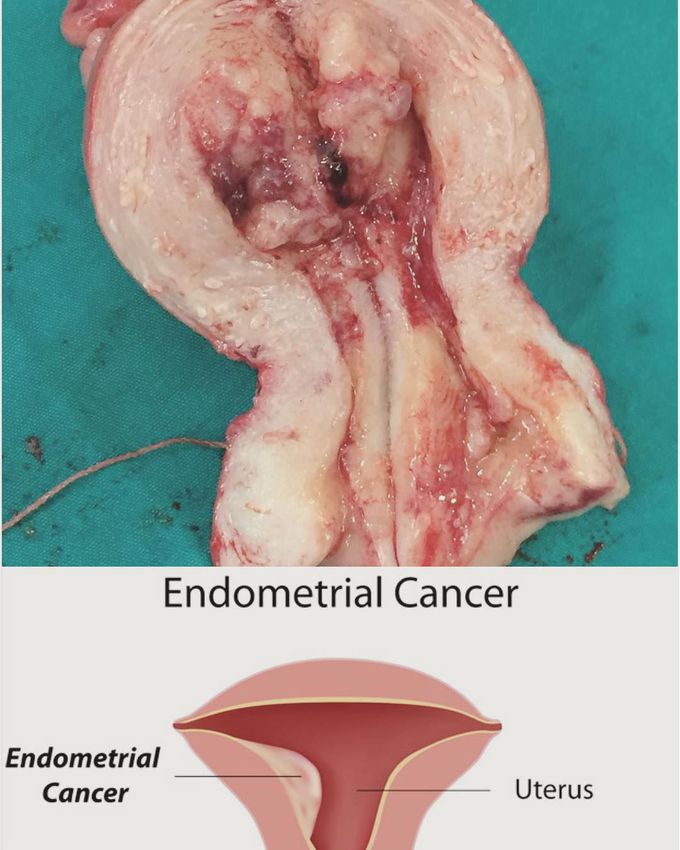 Endometrial cancer