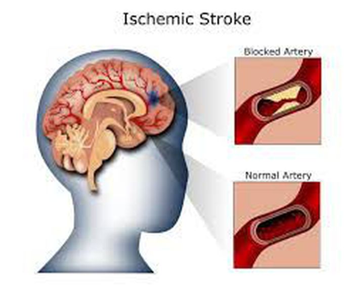 Ischemic stroke