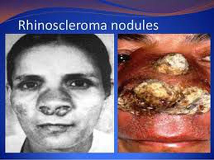 Rhinoscleroma