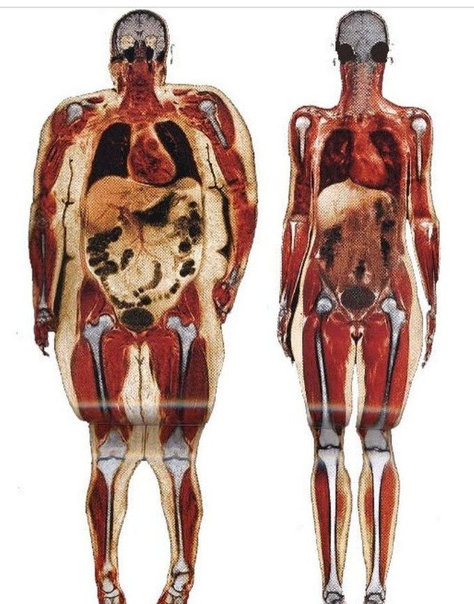 Obesity - MEDizzy