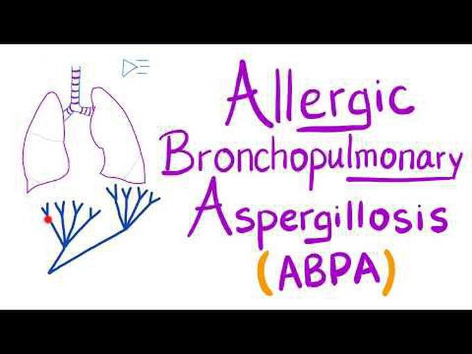 Allergic Bronchopulmonary Aspergillosis (ABPA)