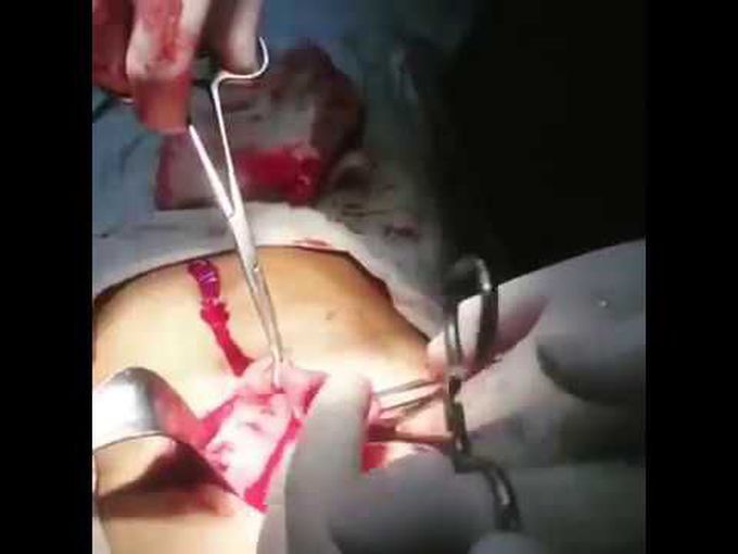 PICA | The eating disorder | Man swallowed 32 toothbrushes and much more |