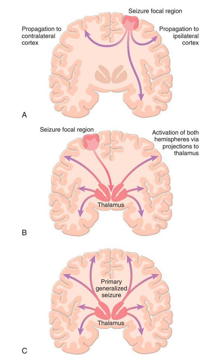 Focal seizures