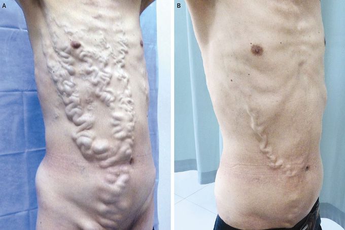 Abdominal-Wall Varices in the Budd–Chiari Syndrome