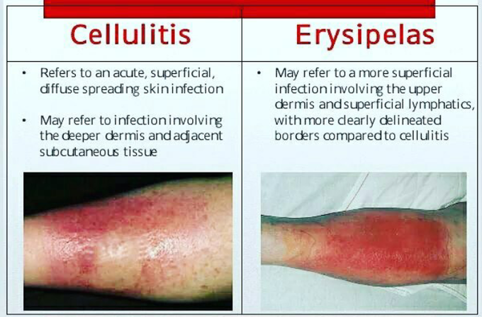 Cellulitis vs erysipelas