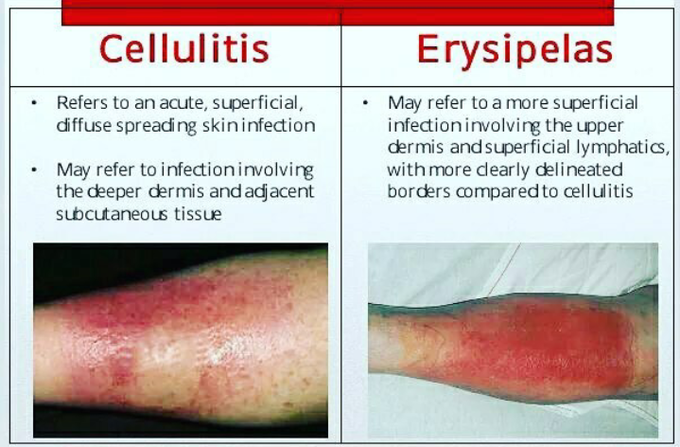 Cellulitis vs erysipelas - MEDizzy