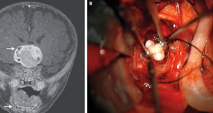 Toothy brain tumor