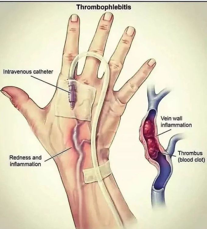 Thrombophlebitis