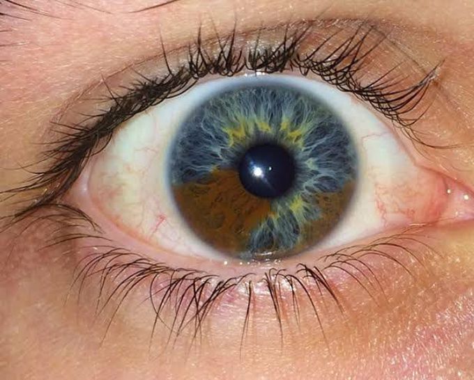 Heterochromia iridis