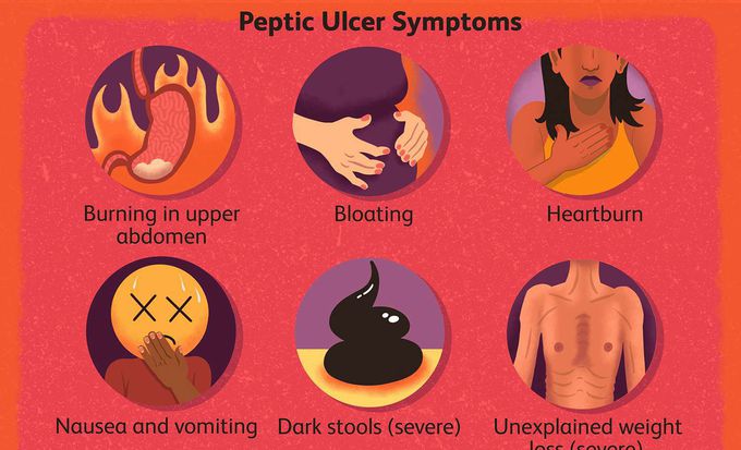 Symptoms of Peptic Ulcer