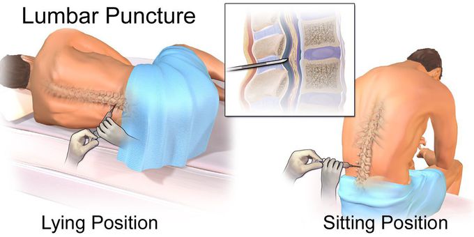 Lumbar puncture position