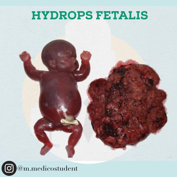 Hydrops Fetalis - MEDizzy