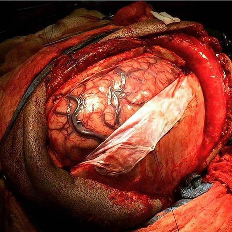 Fantastic photo of the brain (subdural empyema) 