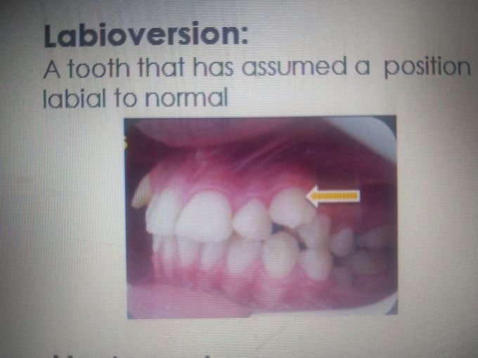 Labioversion tooth