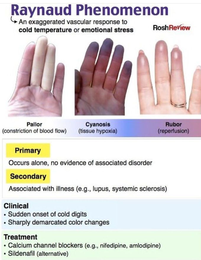 Raynaud's Phenomenon
