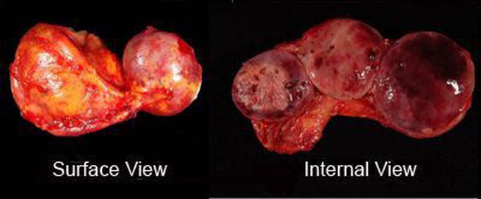 Pheochromocytoma