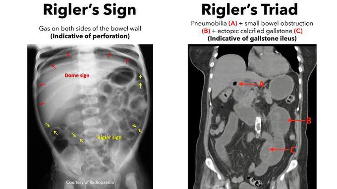 Rigler's triad