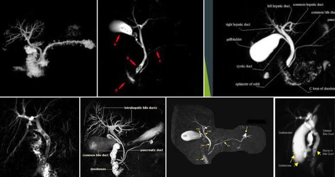 Magnetic Resonance Cholangiopancreatography (MRCP)!