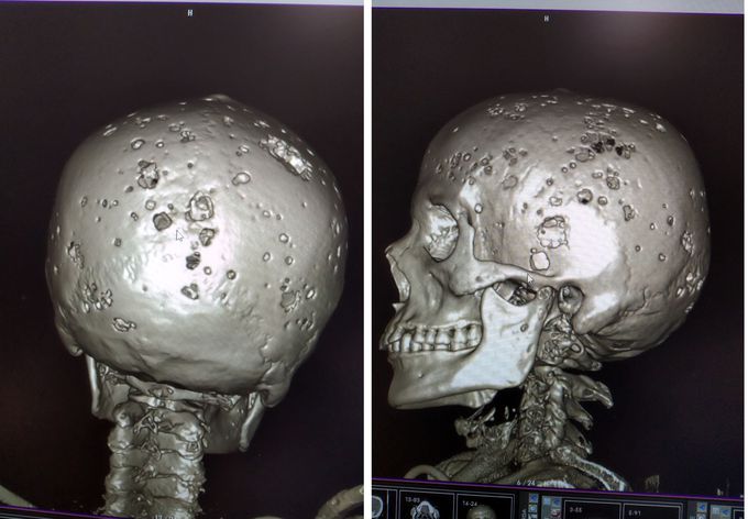 Multiple myeloma