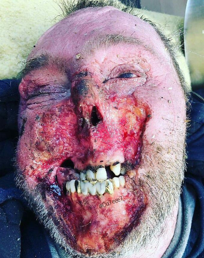 Rat eaten face of a 47 year old man
