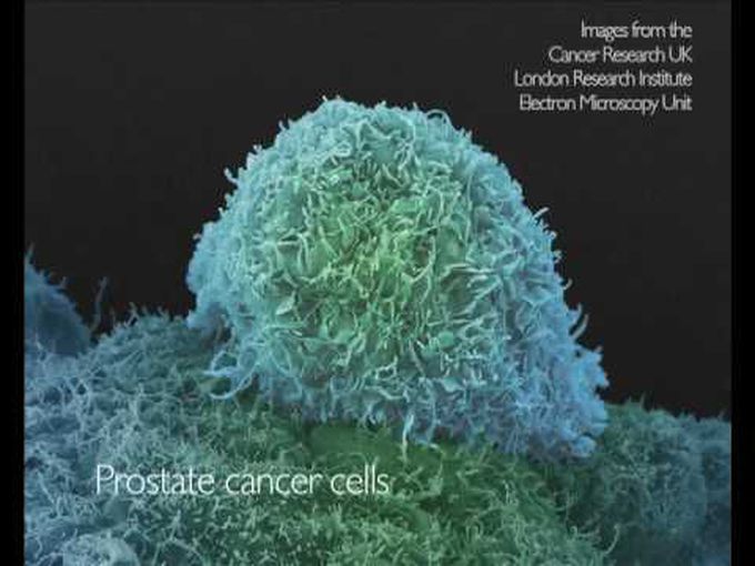 Cancer cells viewed in the electron microscope - Better understanding of Electron microscope