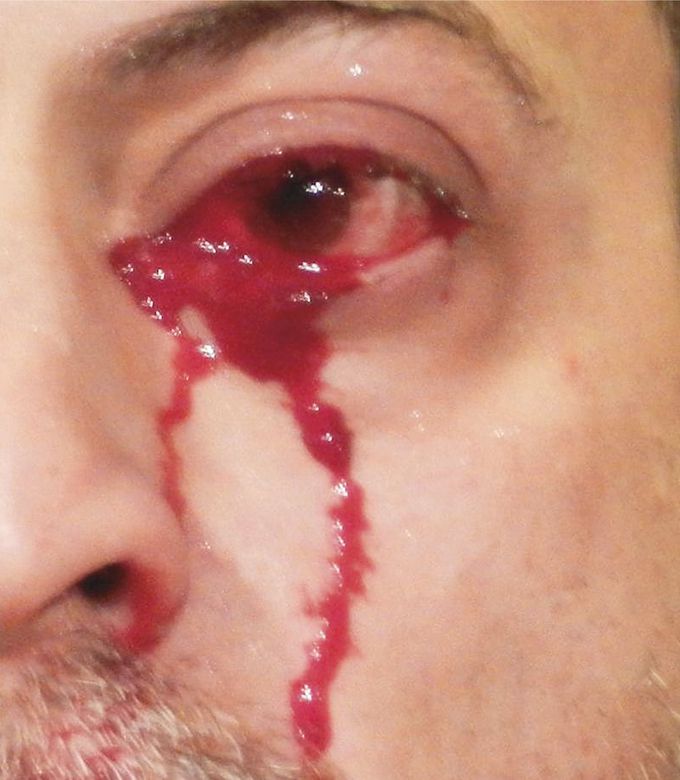 Hemolacria — Crying Blood
