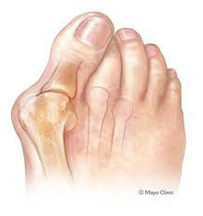 Types of bunions