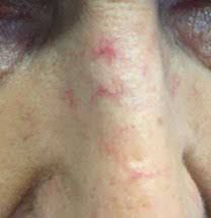What are the symptoms of spider nevus?