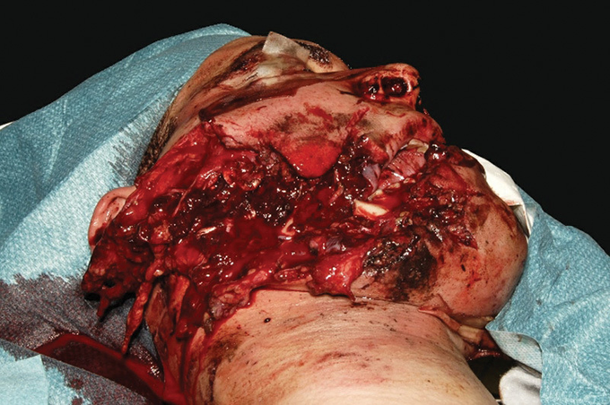 Facial Trauma Caused By Recreational Fireworks In 29-Year-Old