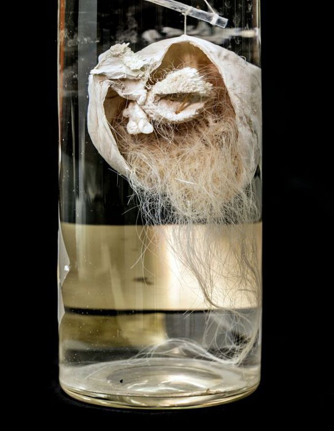 Dermoid Cyst of the Ovary
