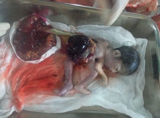 "Omphalocele " condition in which intestine is exposed, covered only with thin tissue.  