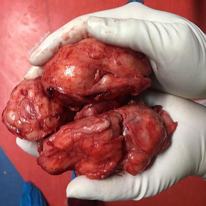 You’ve never seen a benign prostatic hyperplasia that big!! 