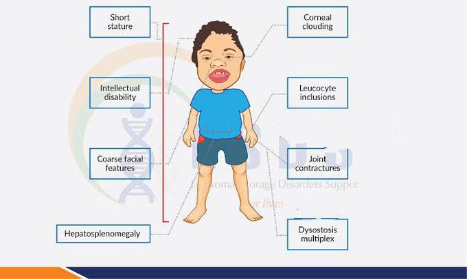 These are the symptoms of Maroteaux-lamy syndrome