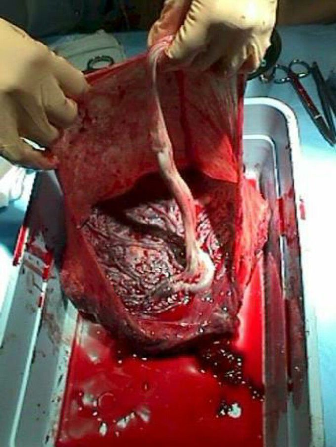 Normal labor and delivery