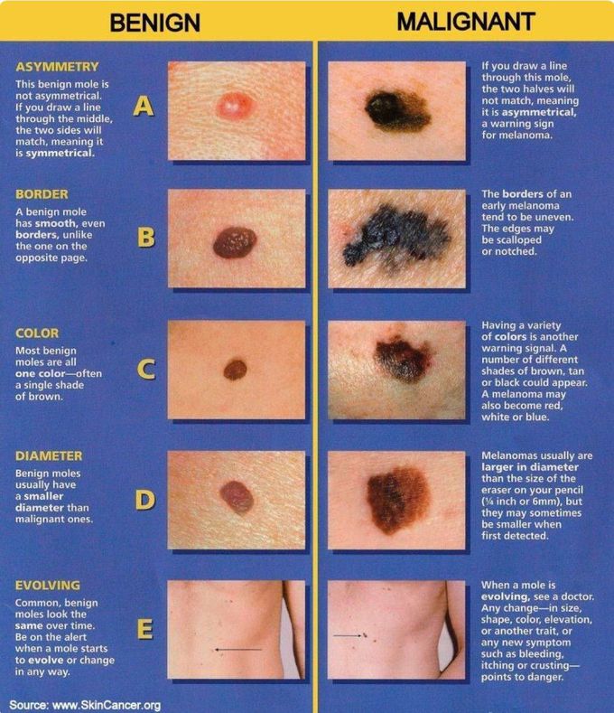 Benign Mole Vs Malignant Mole