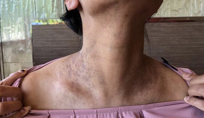 Diagnosis ?