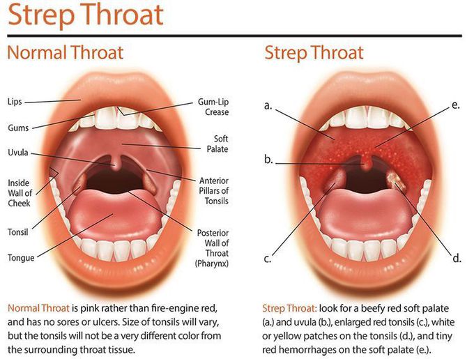 normal throat vs strep throat