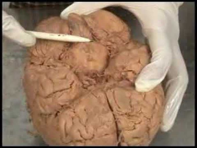 Brain stem