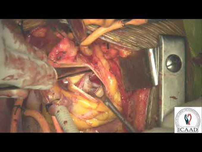 Left Ventricular Outflow Tract Aneurysm Compressing the Left Main
