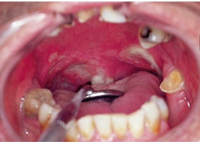 Midline granuloma as oropharyngeal ulcer