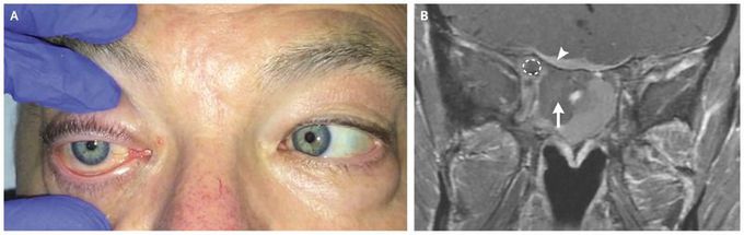 Orbital Apex Syndrome