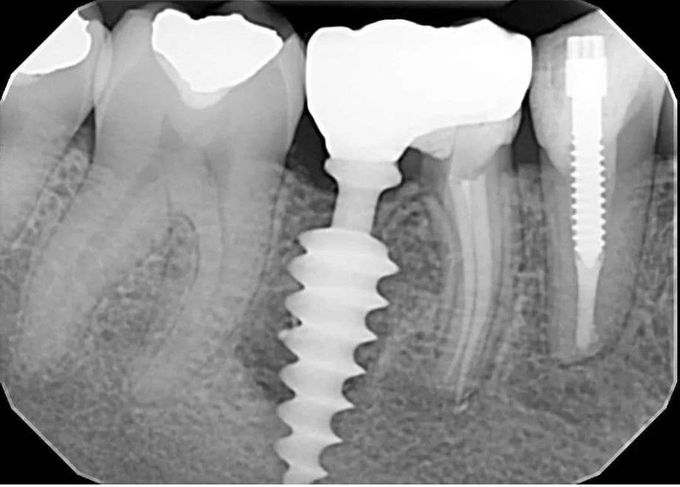 Implant Failure