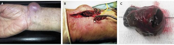 Pseudoaneurysm after Transradial Coronary Angiography